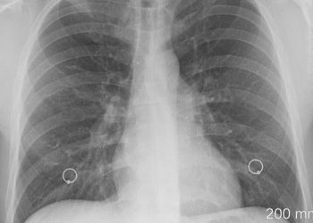 Duken të padëmshme dhe injorohen: Këto janë shenjat e para të kancerit të mushkërive sipas ekspertëve!