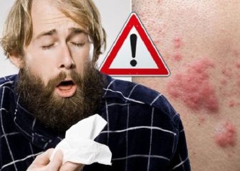 Simptomat e koronavirusit/ Shenja e re COVID-19 në lëkurën tuaj….I keni këto pika të kuqe?