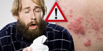 Simptomat e koronavirusit/ Shenja e re COVID-19 në lëkurën tuaj….I keni këto pika të kuqe?