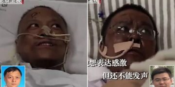 Covid-19, të infektuar nga koronavirusi, dy mjekëve kinezë u ndryshoi ngjyra e lëkurës