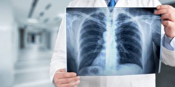 Pacientët e shëruar nga Covid-19 do të kenë probleme me frymëmarrjen dhe plagë të parikuperueshme në mushkëri