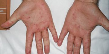 Tritan Kalo nxjerr pamjet e rënda: Mos u fokusoni vetëm te Covid-19, ka shumë infeksione…