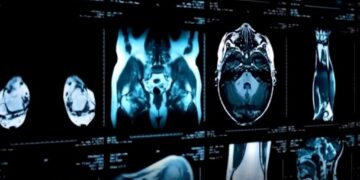 Kanceri, ndër “vrasësit” kryesor të shqiptarëve