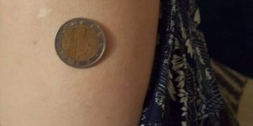 Magneti në trup pas vaksinimit dhe monedha që qëndrojnë mbi lëkurë? Mjeku zbulon si qëndron e vërteta