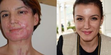 E sulmuan me acid në fytyrë në mes të Tiranës, Dule: Rindërtova fytyrën time, jetën time dhe qepja shpirtin tim si një enigmë