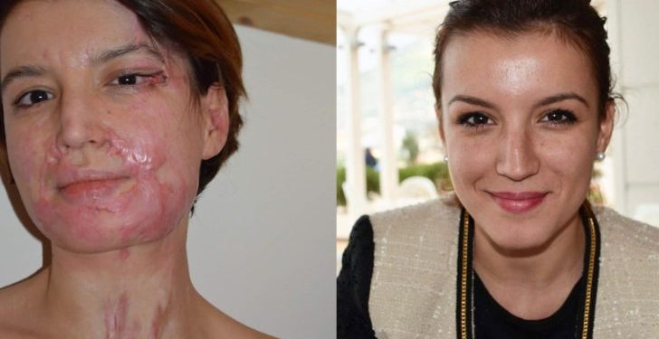 E sulmuan me acid në fytyrë në mes të Tiranës, Dule: Rindërtova fytyrën time, jetën time dhe qepja shpirtin tim si një enigmë